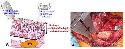 Detectable depth of unexposed parathyroid glands using near-infrared autofluorescence imaging in thyroid surgery